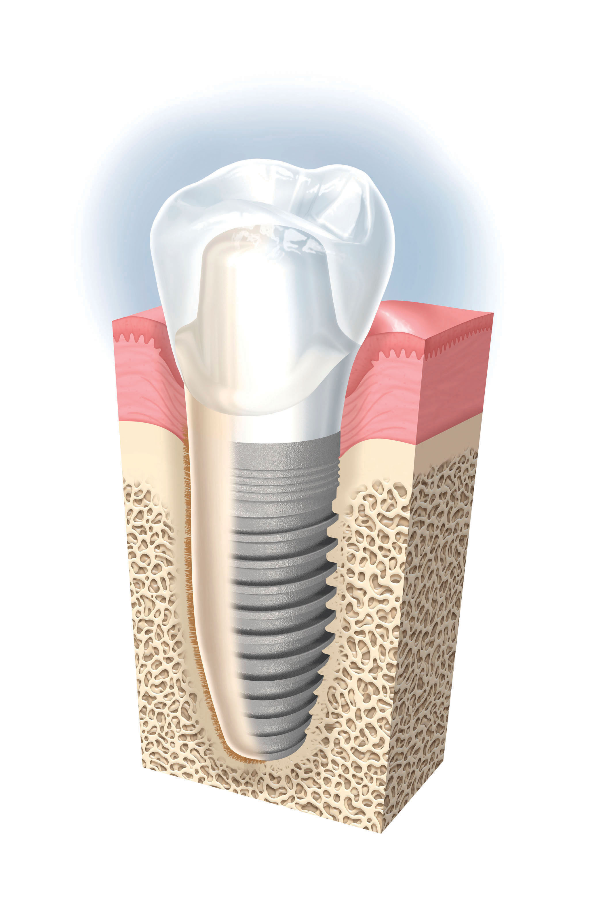 Diagram of single implant